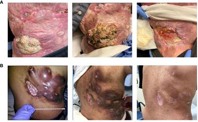 Case report: Increased efficacy of cetuximab after pembrolizumab failure in cutaneous squamous cell carcinoma